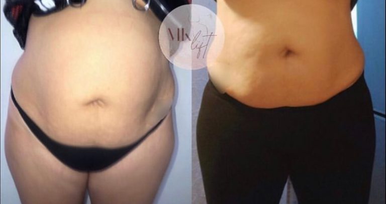 resultat-lipocavitation-mklift-01